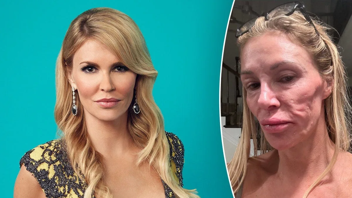 Is it Worth it? What Happens in the Body after Botox?