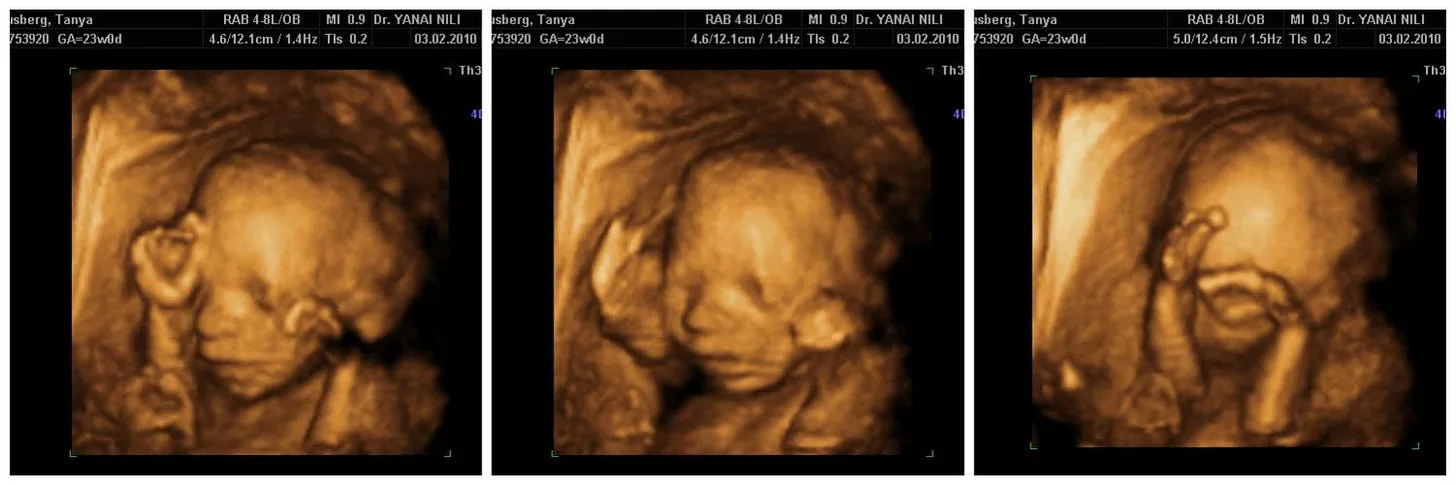 Is Ultrasound During Pregnancy Linked to Fetal Brain Injury and Autism?