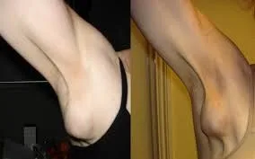 Gigantomastia and C-Sections: Gender-Specific Effects of COVID Shots on Women