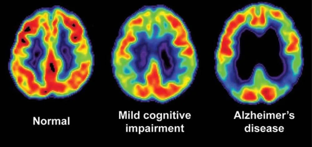 Root Causes of Mental Illness and Neurodegenerative Diseases, in Simple Terms: Part I