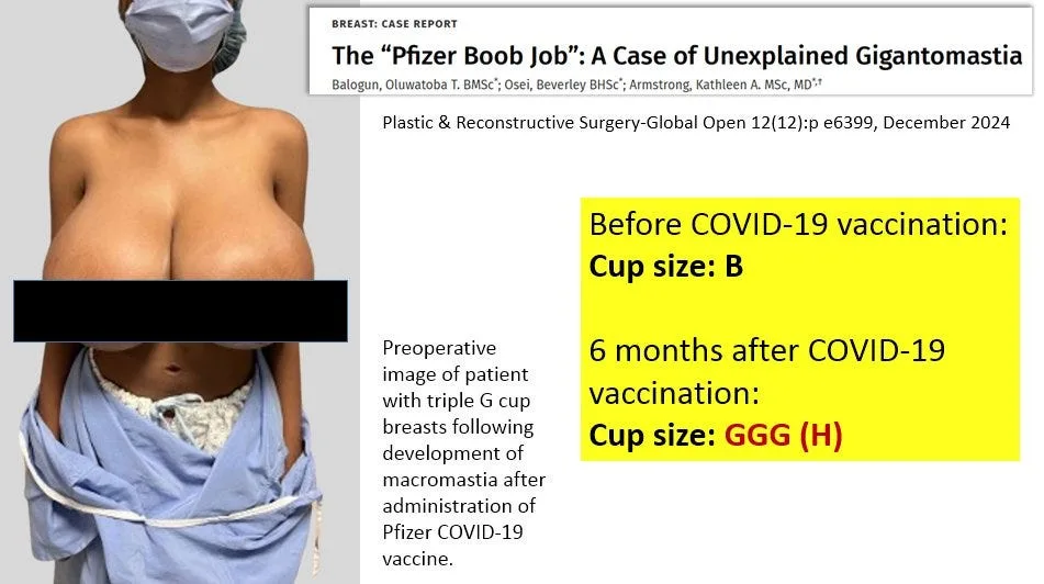 Gigantomastia and C-Sections: Gender-Specific Effects of COVID Shots on Women